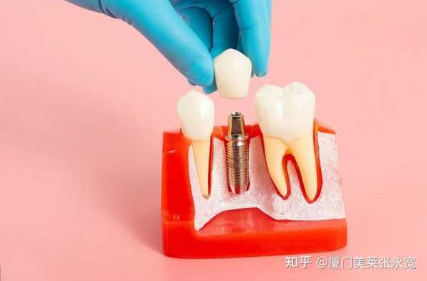 双磷酸盐拔牙种牙需谨慎!