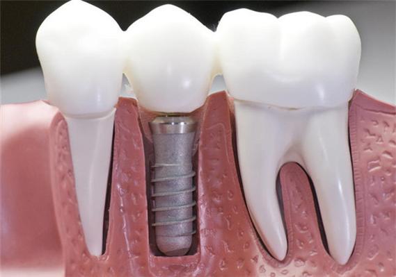 双磷酸盐停多久可以种植牙齿-双磷酸盐停多久可以种植牙