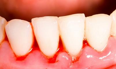 焦磷酸盐能预防牙龈出血吗