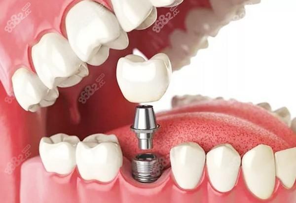 双磷酸盐对种植牙的影响-注射双磷酸盐能戴牙套吗